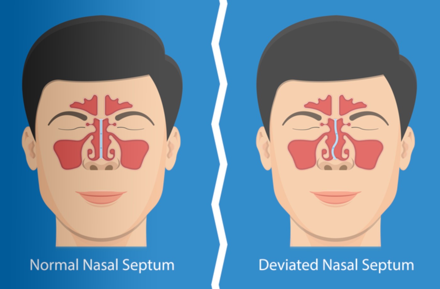 How To Fix A Deviated Septum Without Surgery